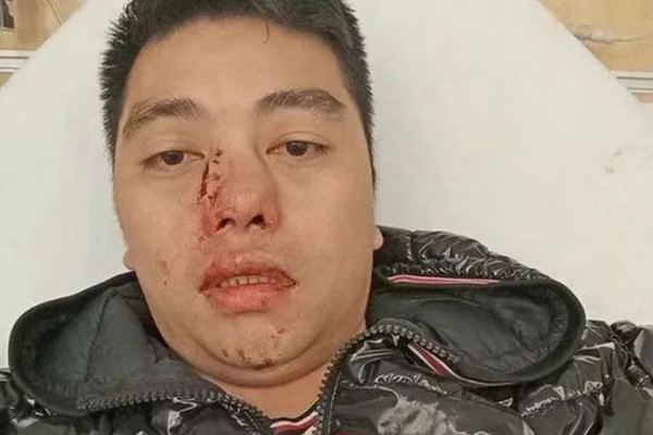 缩略图 | 36岁华人遭一元店黑人员工嫌弃英文差，被殴打至颅内出血！